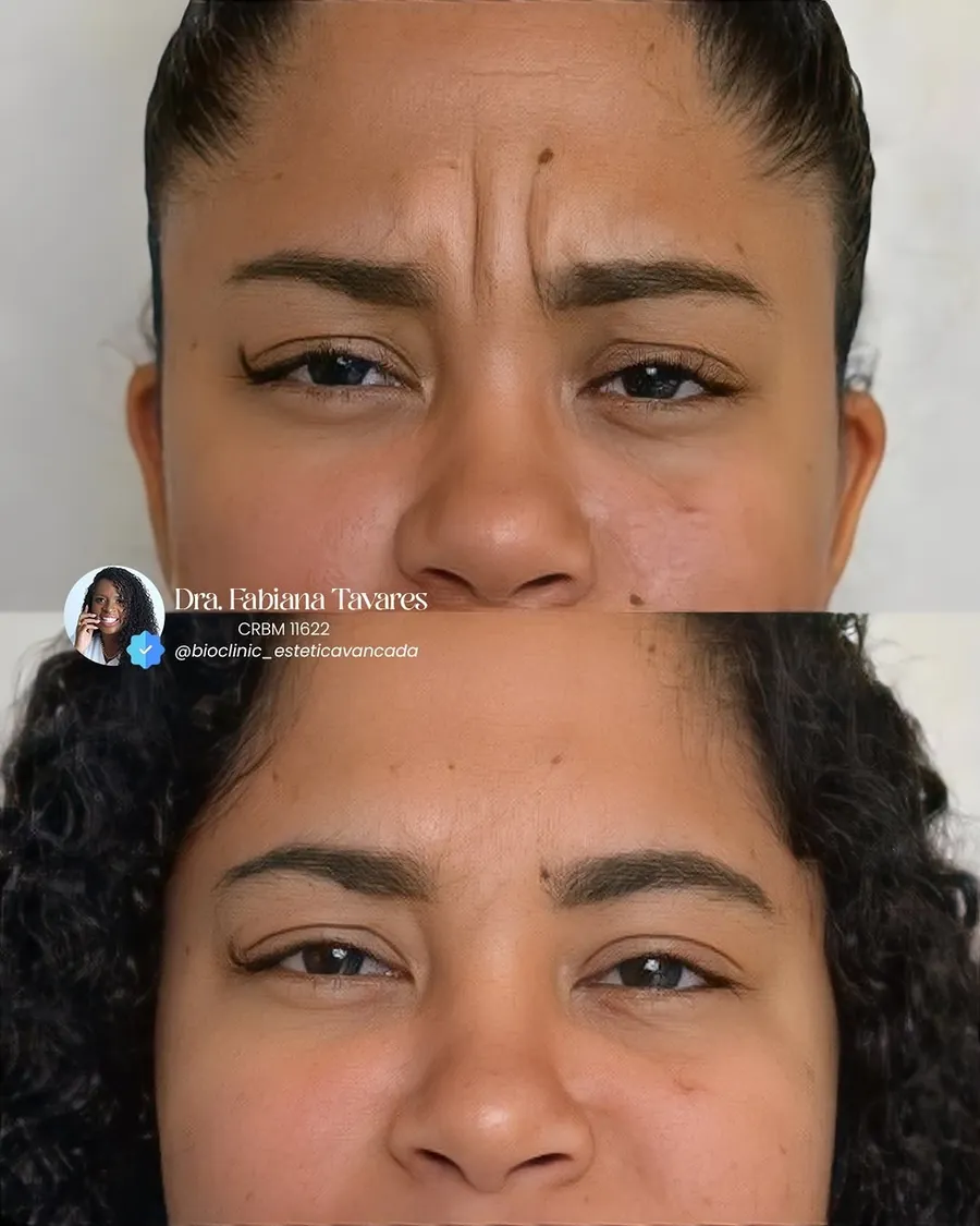 Testa e região entre as sobrancelhas antes e depois da toxina botulínica