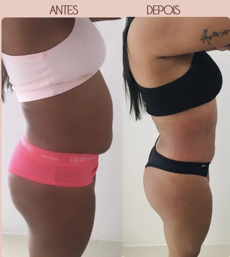 Abdômen antes e depois de protocolo corporal
