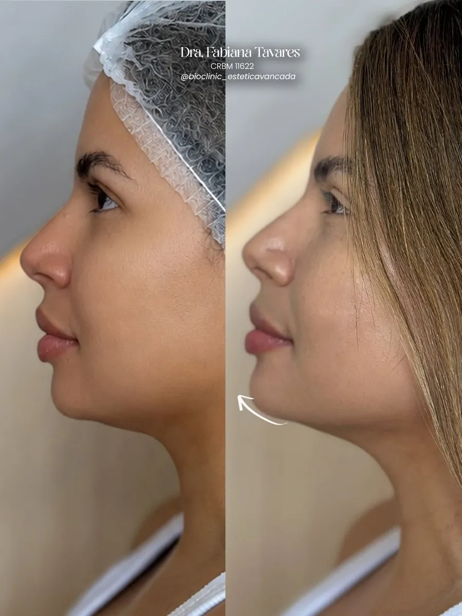 Perfil antes e depois do preenchimento de mento
