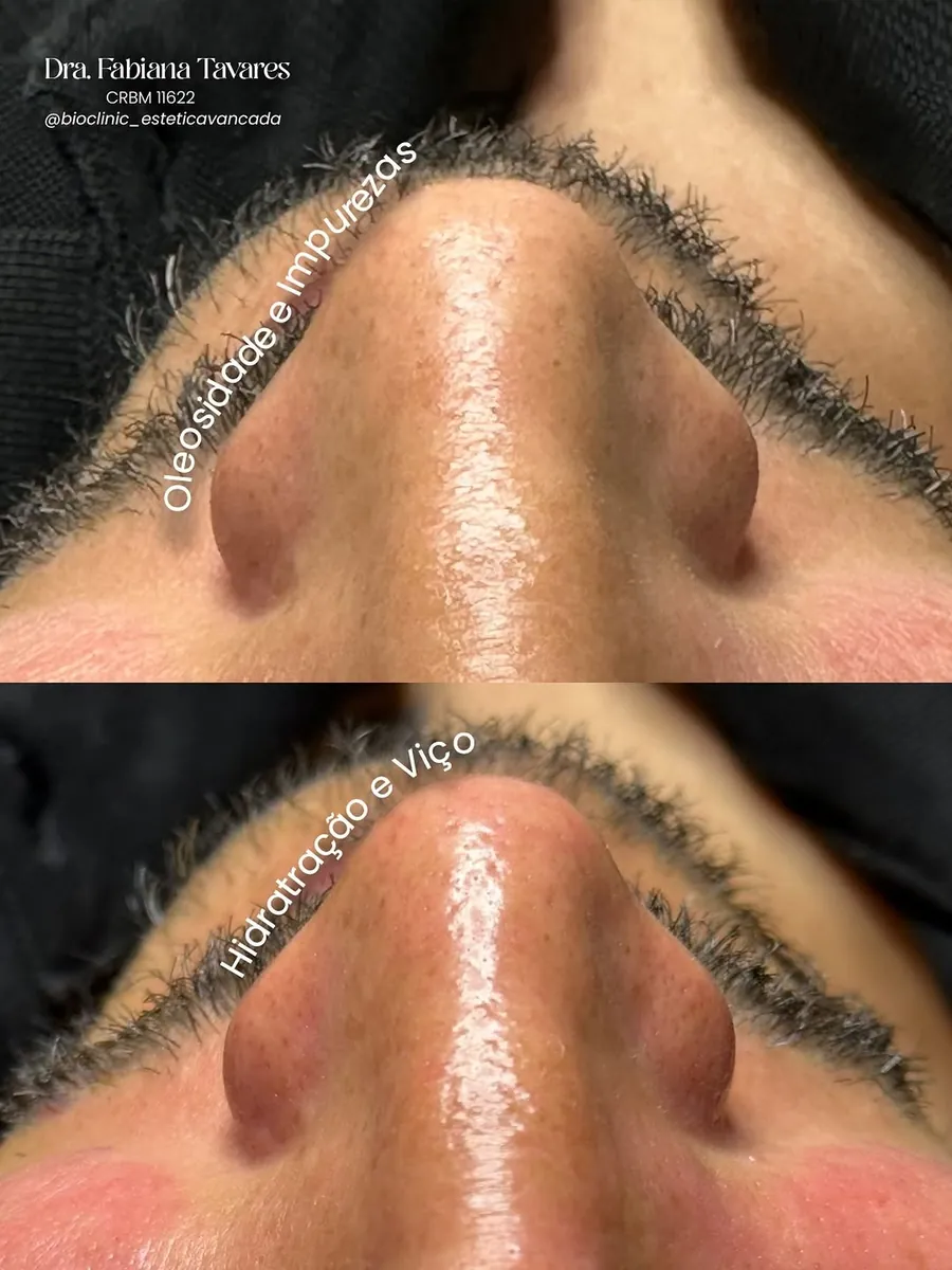 Pele do nariz antes e depois: de oleosidade e impurezas para hidratação e viço